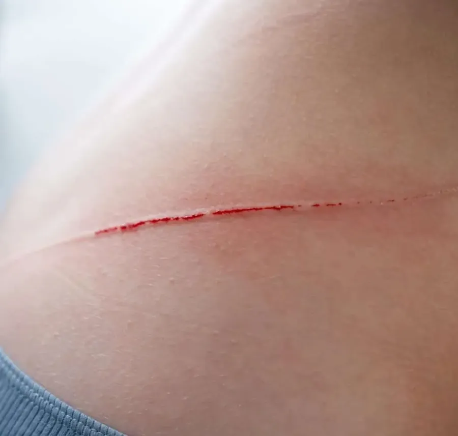 Cuts & Lacerations